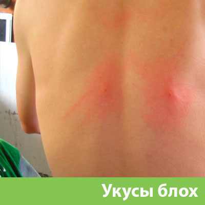 Укусы блох в Азнакаево