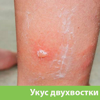 Укус двухвостки в Азнакаево