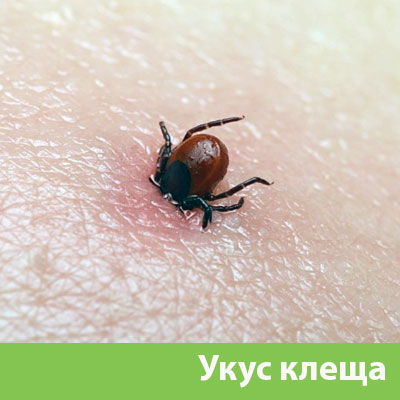 Укус клеща в Азнакаево
