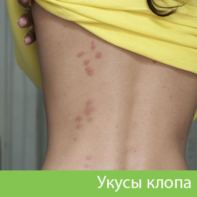 Профессиональное уничтожение клопов в Азнакаево